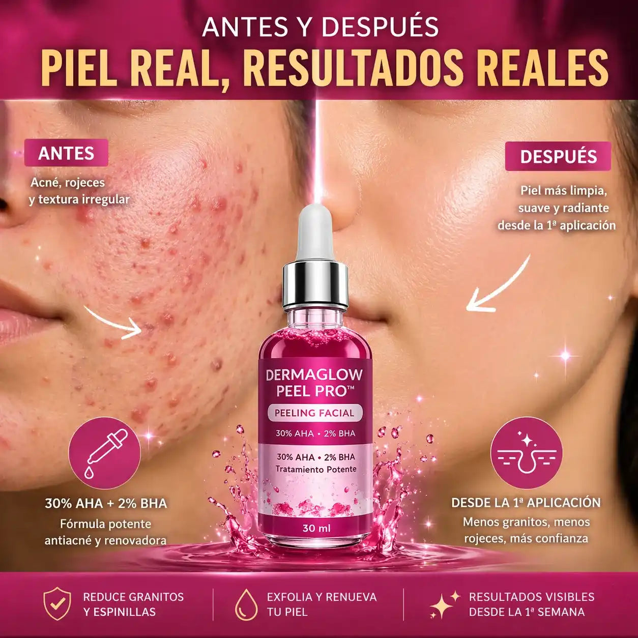 DermaGlow Peel Pro™ – Exfoliación Profunda para Eliminar Acné, Puntos Negros y Manchas