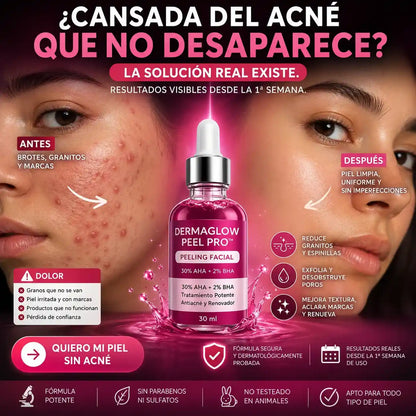 DermaGlow Peel Pro™ – Exfoliación Profunda para Eliminar Acné, Puntos Negros y Manchas