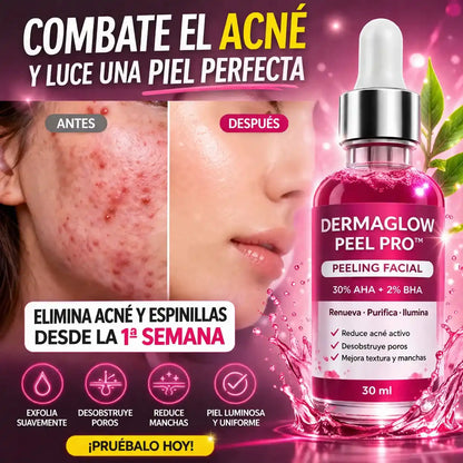 DermaGlow Peel Pro™ – Exfoliación Profunda para Eliminar Acné, Puntos Negros y Manchas